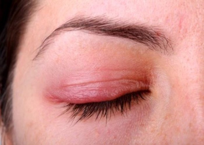 Inflammation of eyelids