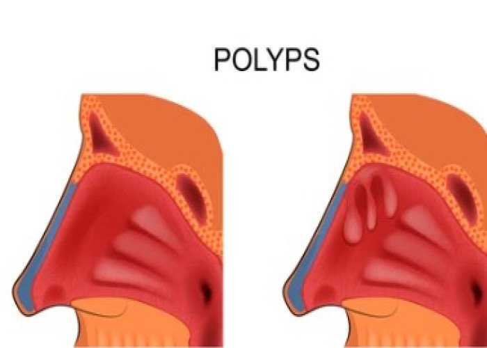 Polypus