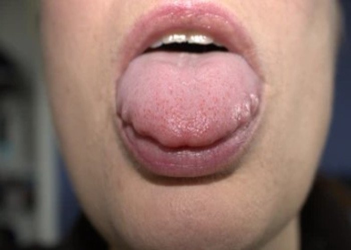 Swollen tongue