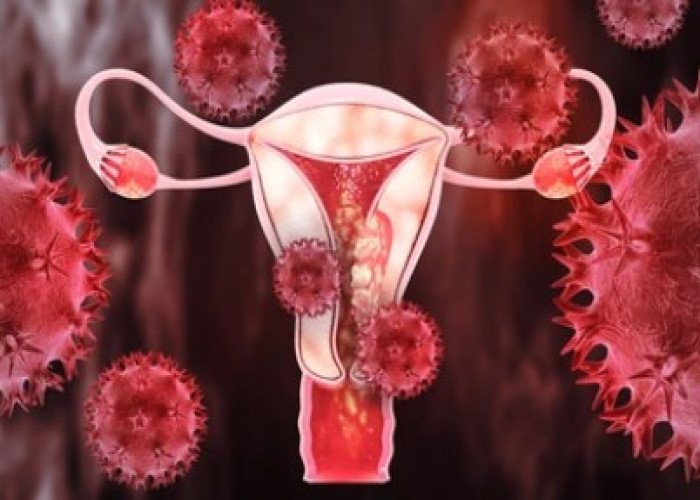 Uterine cancer