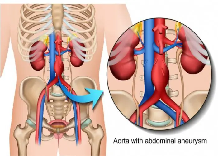 Abdominal aortic aneurysm