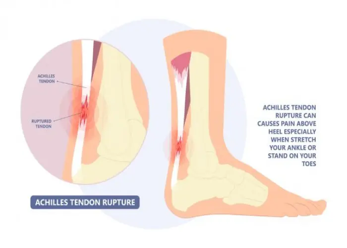 Achilles tendon rupture