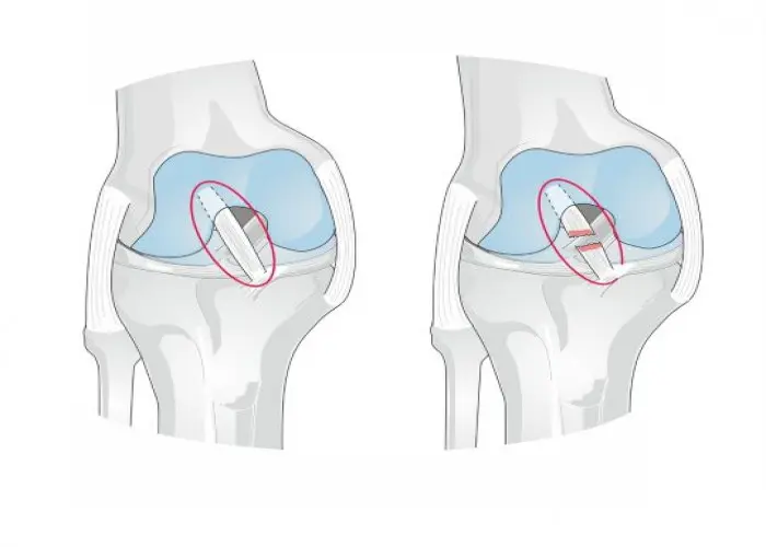 ACL injury