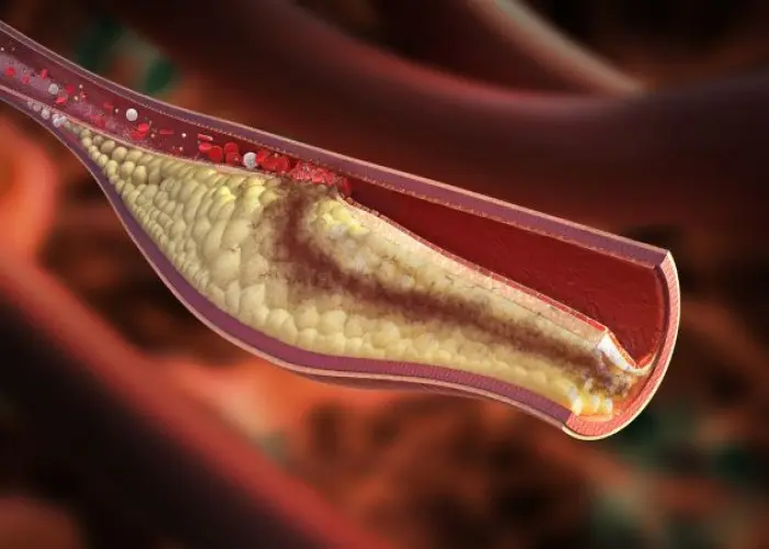 Acute coronary syndrome