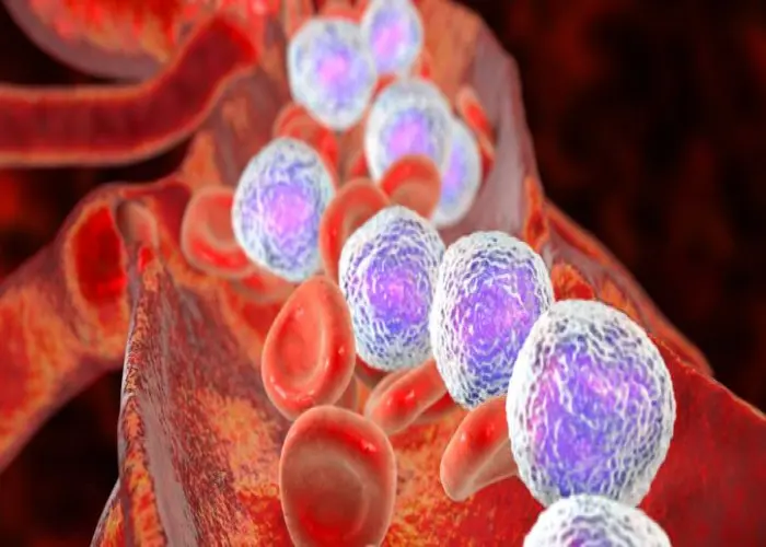 Acute lymphocytic leukemia