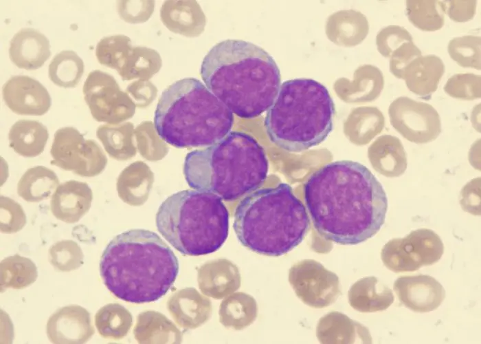 Acute myelogenous leukemia