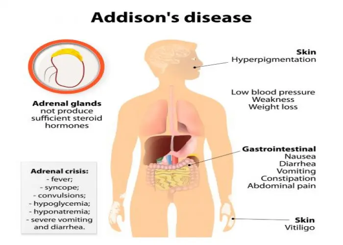 Addison's disease