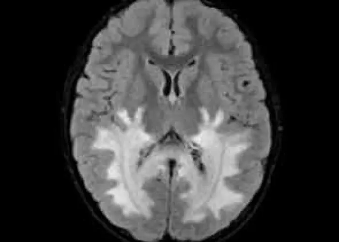 Adrenoleukodystrophy