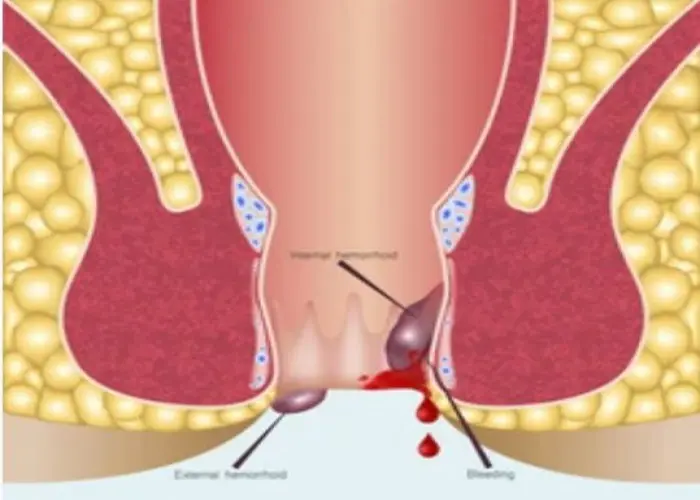 Anal fissure