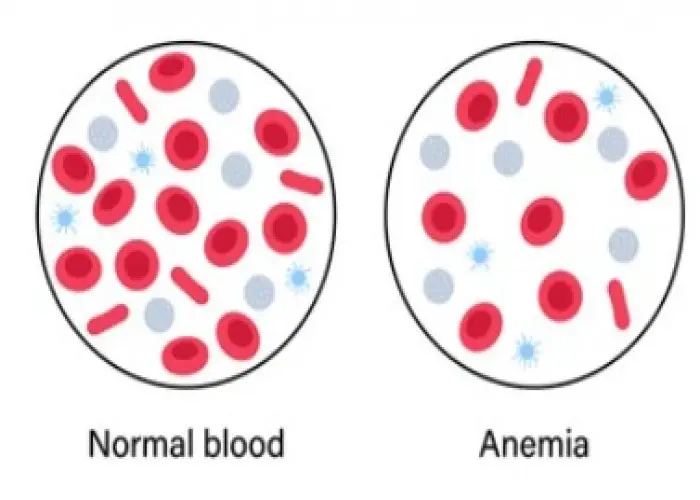 Anemia