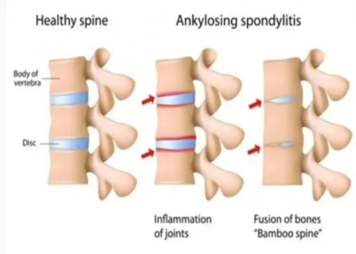 Ankylosing spondylitis