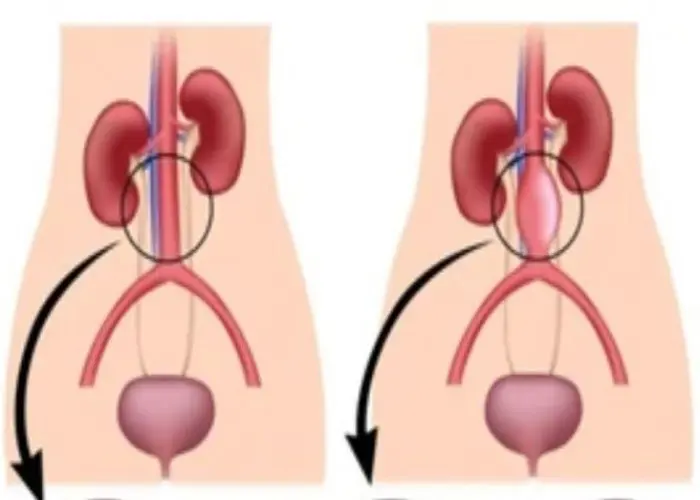 Aortic aneurysm