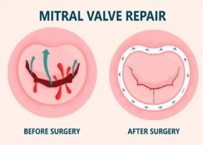 Aortic valve disease