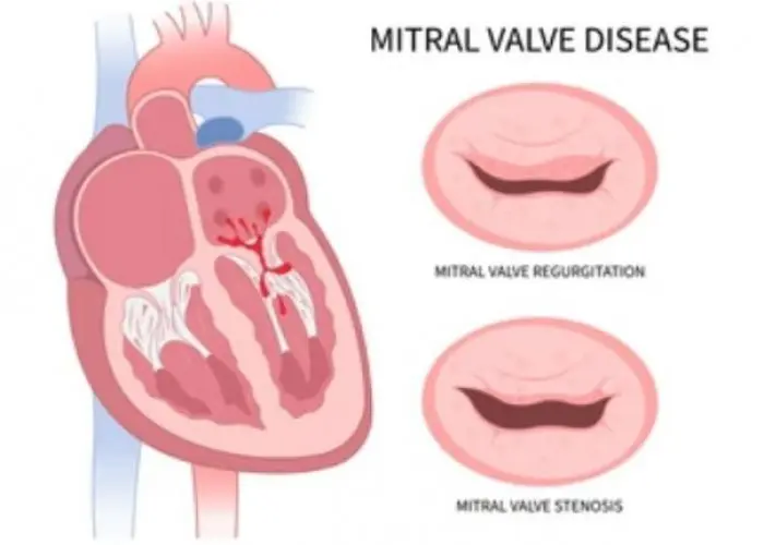 Aortic valve regurgitation