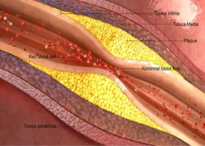 Arteriosclerosis / atherosclerosis