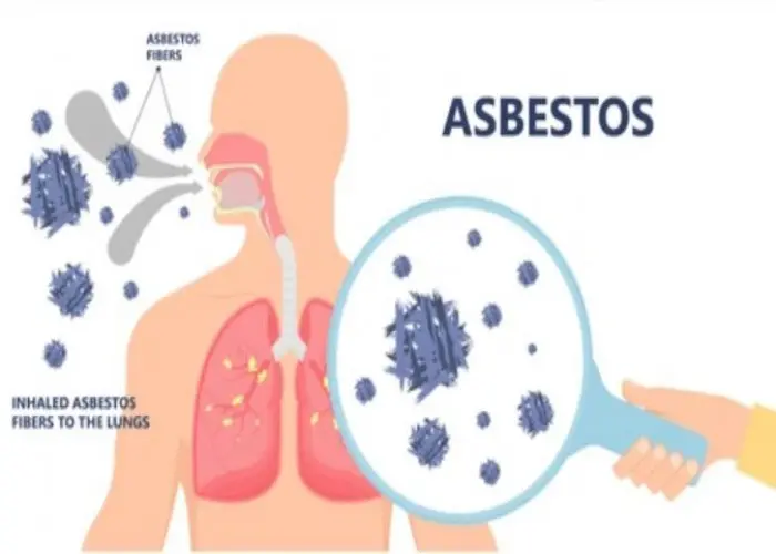 Asbestosis