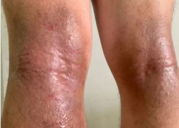 Atopic dermatitis (eczema)