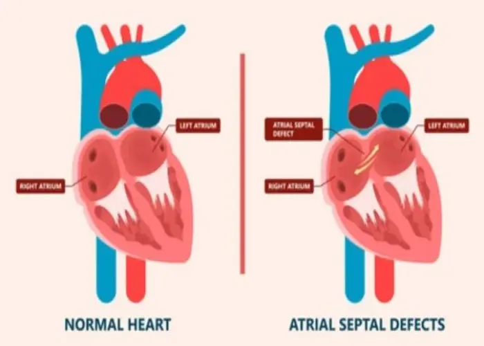 Atrial septal defect (ASD)