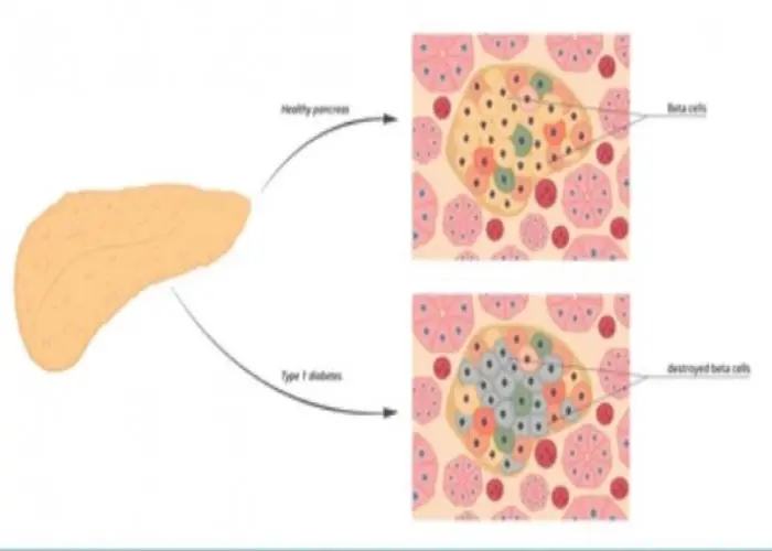 Autoimmune pancreatitis