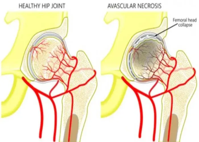 Avascular necrosis