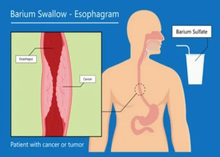 Barrett's esophagus