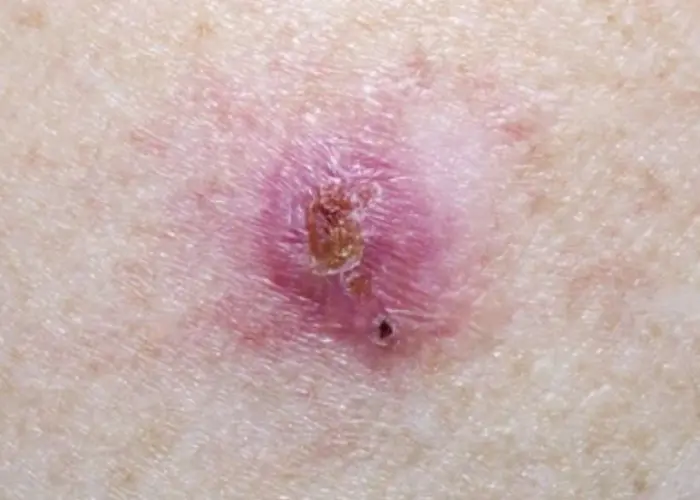 Basal cell carcinoma