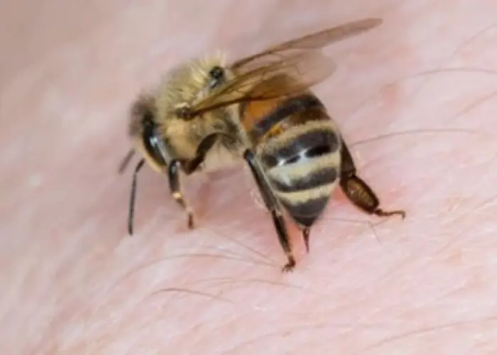 Bee sting