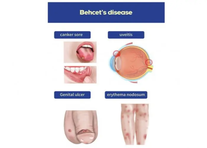 Behcet's disease