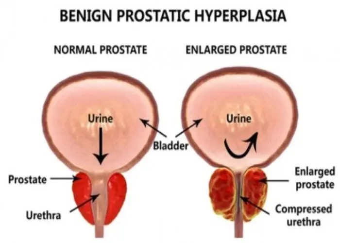 Benign prostatic hyperplasia (BPH)