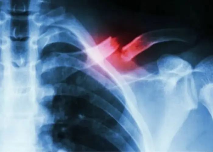 Broken collarbone