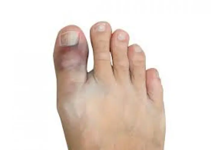 Broken toe