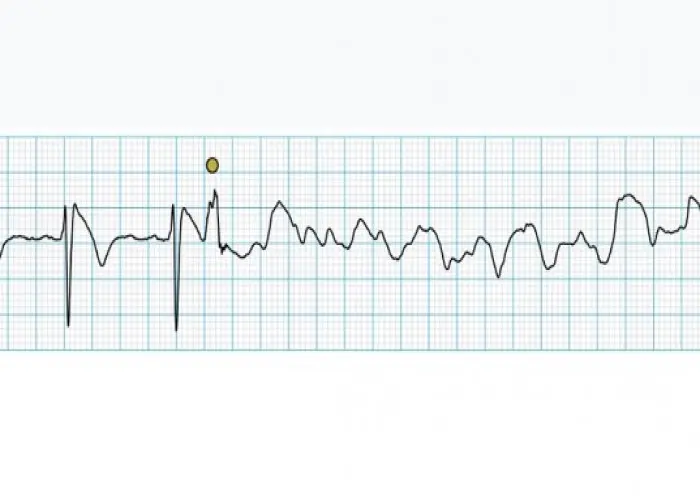 Brugada syndrome