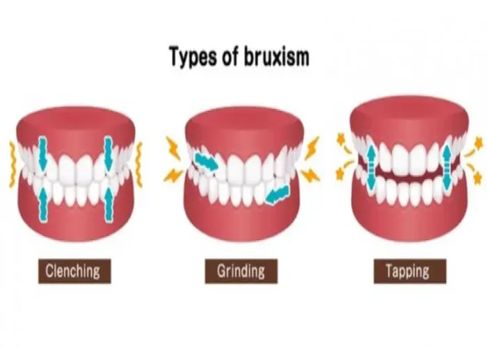 Bruxism (teeth grinding)