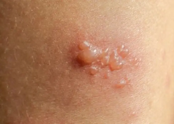 Bullous pemphigoid