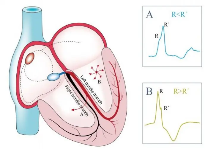 Bundle branch block