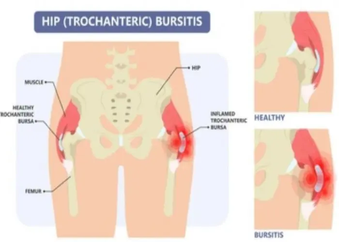 Bursitis