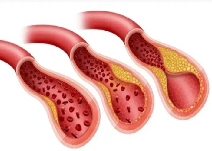 Carotid artery disease