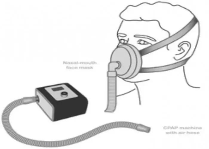 Central sleep apnea