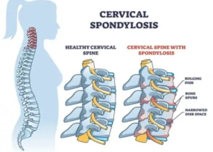 Cervical spondylosis