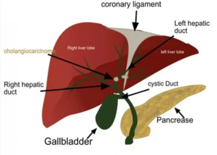 Cholangiocarcinoma (bile duct cancer)