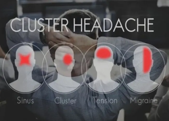 Cluster headache