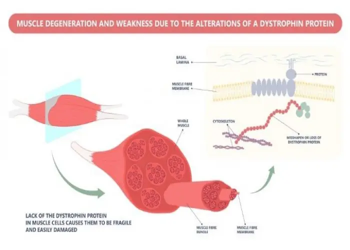 Congenital myopathies