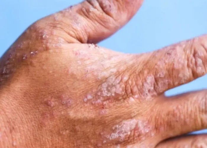 Contact dermatitis