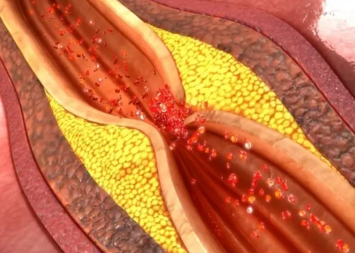 Coronary artery disease