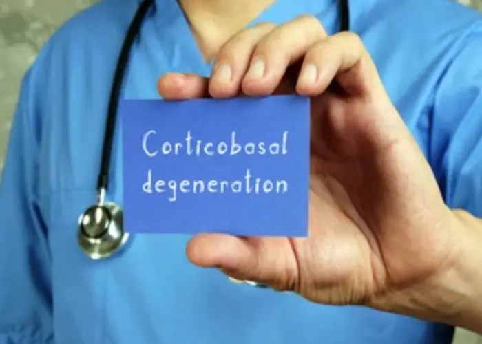 Corticobasal degeneration