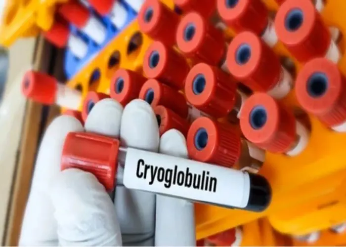 Cryoglobulinemia