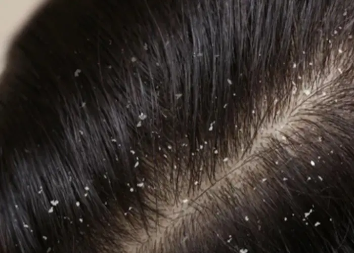 Dandruff