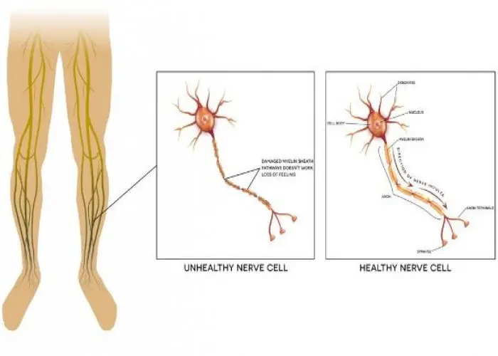 Diabetic neuropathy