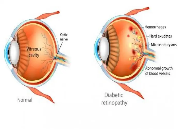 Diabetic retinopathy