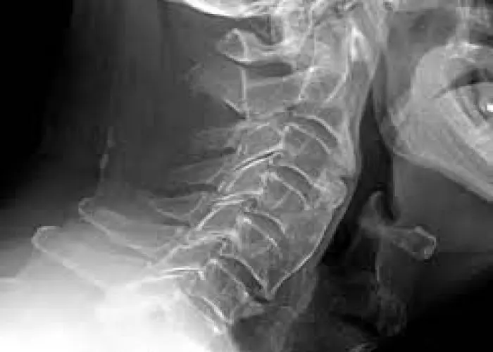 Diffuse idiopathic skeletal hyperostosis (DISH)